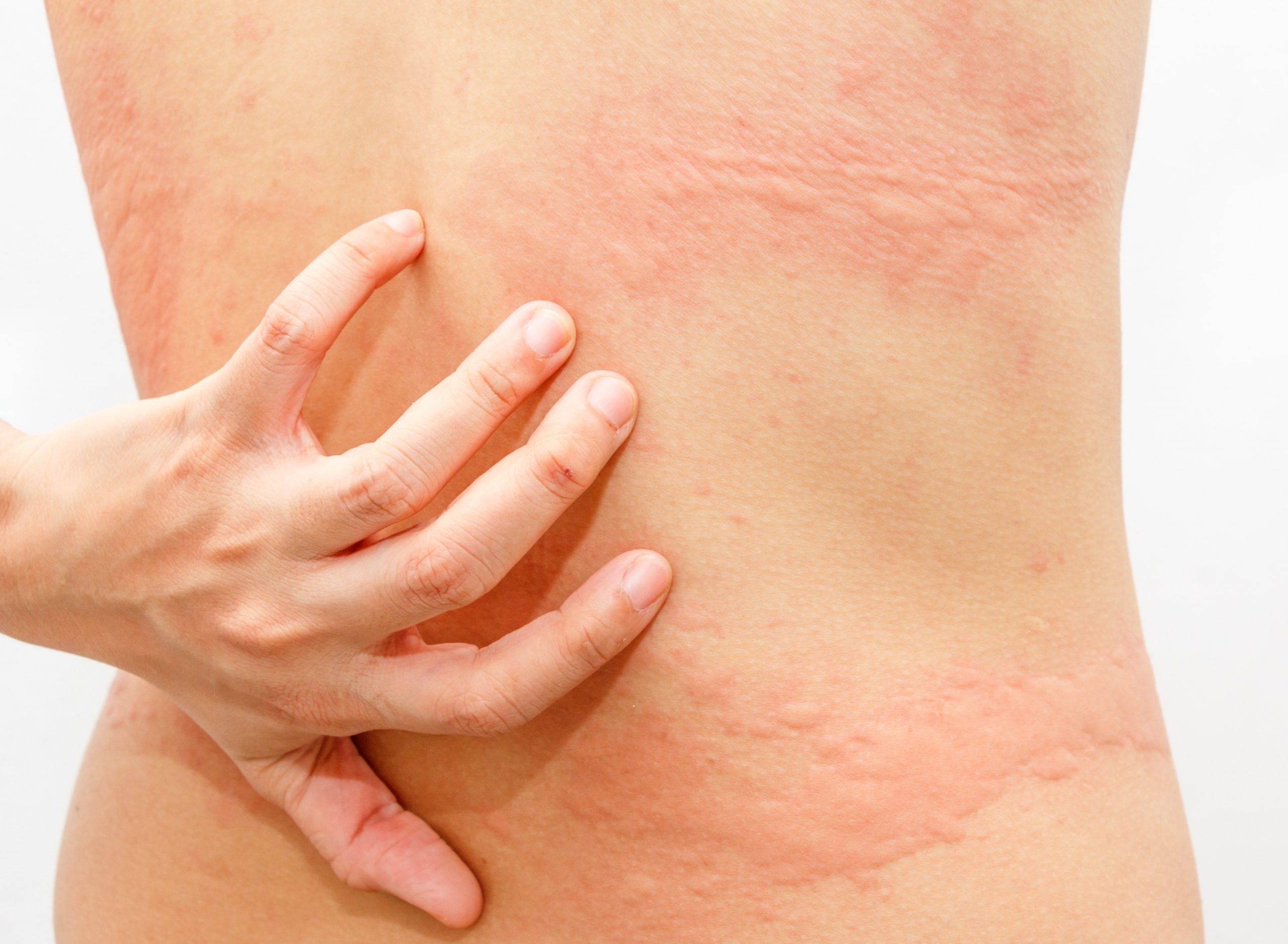 Person with symptoms of itchy urticaria.